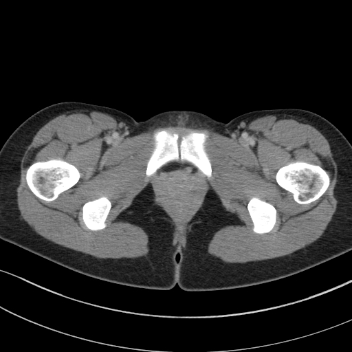 Acute appendicitis (Radiopaedia 62608-70901 Axial C+ portal venous phase 68).jpg
