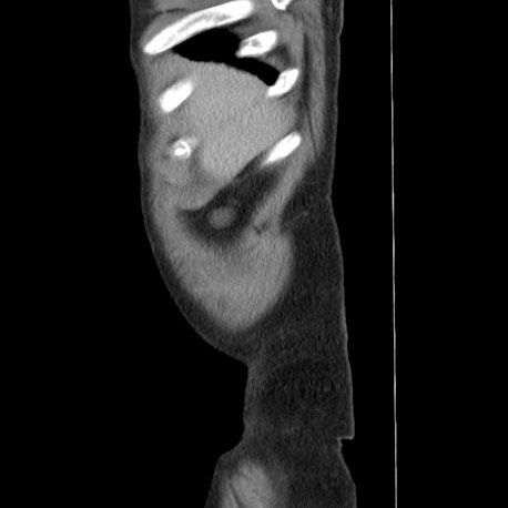 File:Acute appendicitis (Radiopaedia 66513-75790 Sagittal C+ portal venous phase 2).jpg