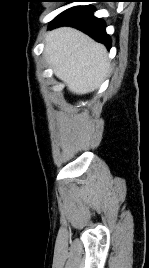 Acute appendicitis (Radiopaedia 77016-88960 Sagittal C+ portal venous phase 101).jpg