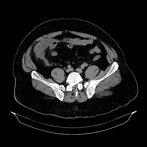 Acute appendicitis (Radiopaedia 79950-93224 Axial non-contrast 73).jpg