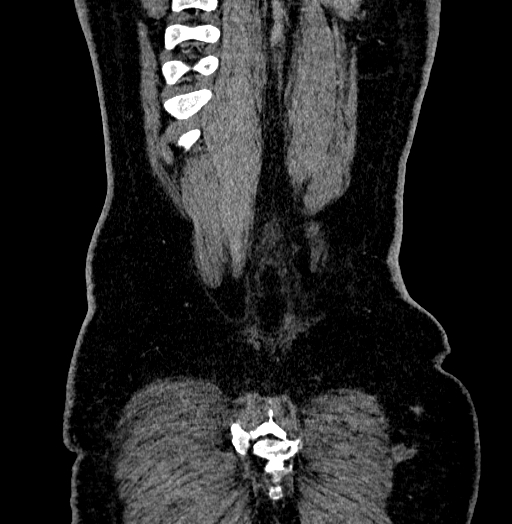 Acute appendicitis (Radiopaedia 79950-93224 Coronal C+ portal venous phase 91).jpg