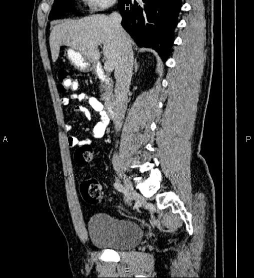 Acute appendicitis (Radiopaedia 84780-100240 Sagittal C+ portal venous phase 42).jpg