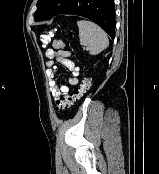 File:Acute appendicitis (Radiopaedia 84780-100240 Sagittal C+ portal venous phase 88).jpg