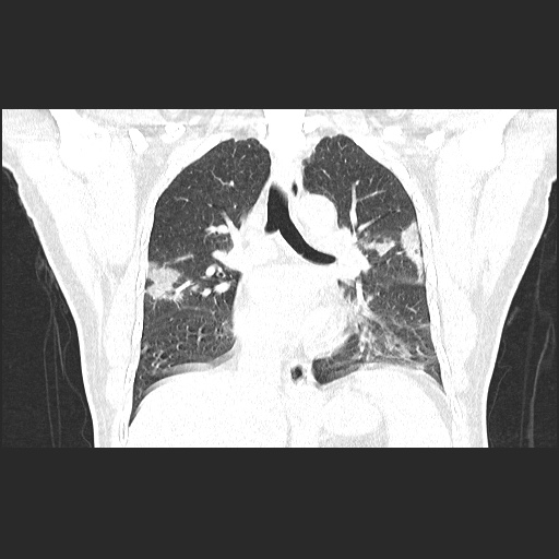 Acute appendicitis and COVID 19 pneumonia (Radiopaedia 76604-88380 G 35).jpg
