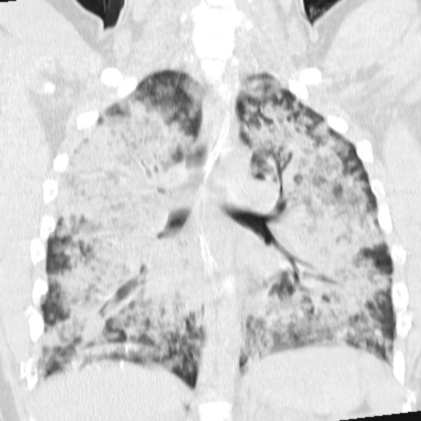 Acute aspiration pneumonitis (Radiopaedia 33605-34703 Coronal lung window 50).jpg