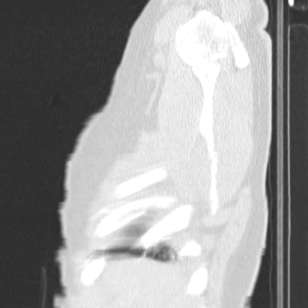 Acute aspiration pneumonitis (Radiopaedia 33605-34703 Sagittal lung window 9).jpg