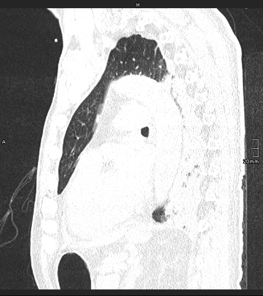 File:Acute aspiration pneumonitis (Radiopaedia 55642-62166 Sagittal lung window 56).jpg