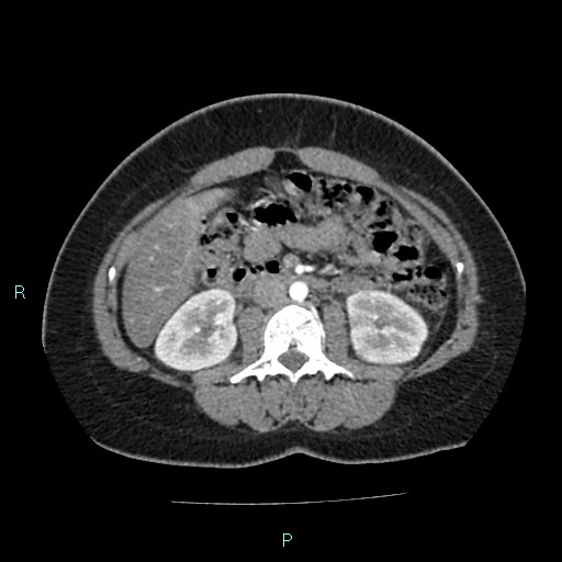 Acute bilateral pyelonephritis (Radiopaedia 37146-38881 Axial C+ arterial phase 89).jpg