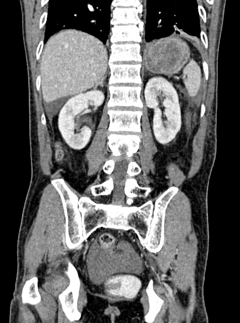 Acute bowel ischemia (Radiopaedia 87695-104114 Coronal C+ portal venous phase 274).jpg
