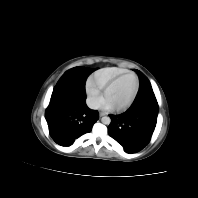 Acute calculous cholecystitis in patient with osteopetrosis (Radiopaedia 77871-90159 Axial C+ portal venous phase 12).jpg
