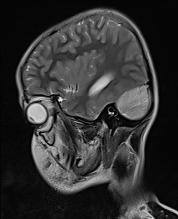 File:Acute cerebellar ataxia (Radiopaedia 61487-69446 Sagittal T2 12).jpg
