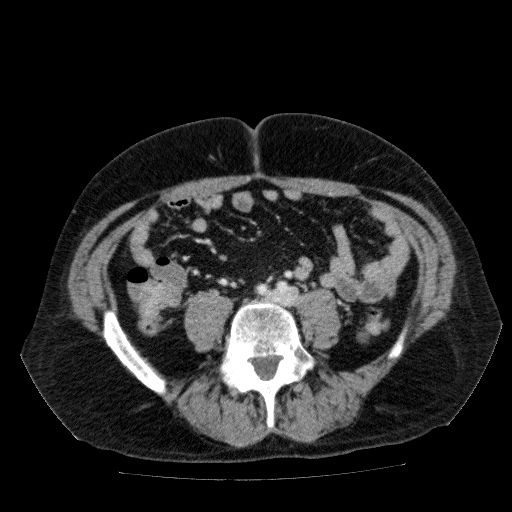 File:Acute cholecystitis and incidental left sided IVC (Radiopaedia 49352-54459 Axial C+ portal venous phase 98).jpg