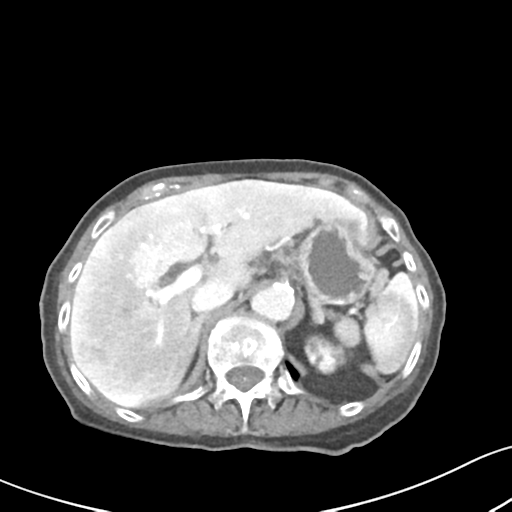 Acute cholecystitis with contained perforation (Radiopaedia 47328-51907 Axial C+ portal venous phase 19).png