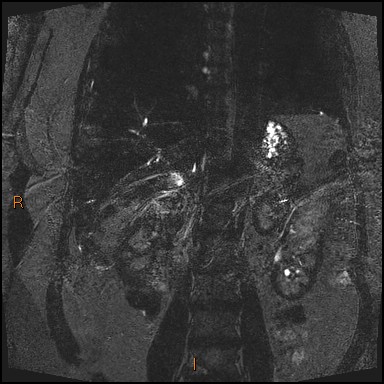 File:Acute cholecystitis with gallbladder neck calculus (Radiopaedia 42795-45971 Coronal Turbo spin echo 8).jpg