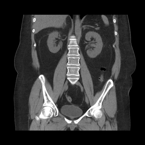 File:Acute cholecystitis with tensile fundus sign (Radiopaedia 71394-81723 Coronal non-contrast 75).jpg
