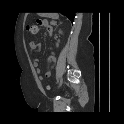 Acute cholecystitis with tensile fundus sign (Radiopaedia 71394-81723 Sagittal non-contrast 107).jpg