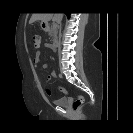 Acute cholecystitis with tensile fundus sign (Radiopaedia 71394-81723 Sagittal non-contrast 84).jpg