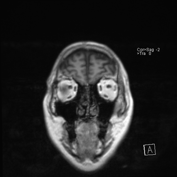 File:Acute disseminated encephalomyelitis (Radiopaedia 37253-39033 Coronal T1 5).jpg