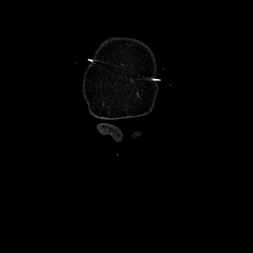 Acute diverticulitis - transverse colon (Radiopaedia 87063-103327 Coronal C+ portal venous phase 11).jpg