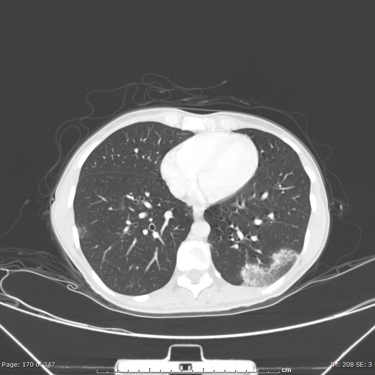Acute eosinophilic pneumonia (Radiopaedia 48211-53073 Axial lung window 61).jpg