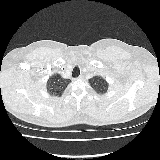 Acute epicardial fat necrosis (Radiopaedia 42327-45440 Axial lung window 11).jpg