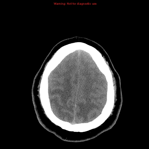 Acute hemorrhagic leukoencephalitis (Radiopaedia 14076-13920 Axial non-contrast 41).jpg