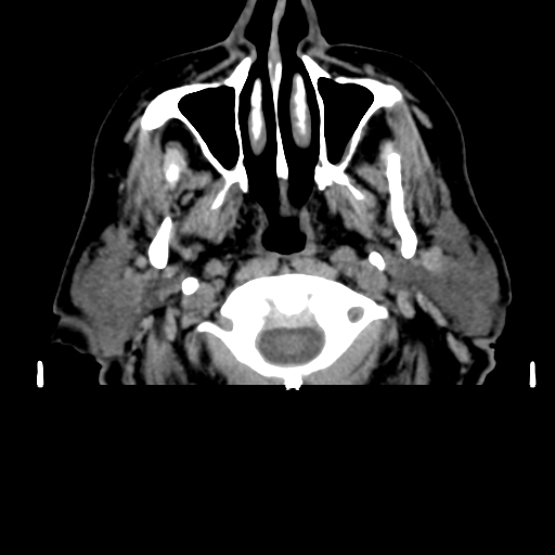 Acute hemorrhagic stroke (Radiopaedia 17507-17223 Axial non-contrast 2).jpg