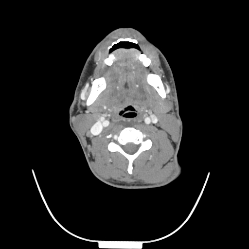Acute longus colli calcific tendinitis (Radiopaedia 72495-83036 Axial C+ arterial phase 42).jpg