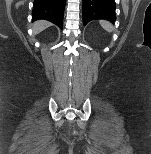 Acute mesenteric venous ischemia (Radiopaedia 46041-50383 Coronal C+ portal venous phase 80).jpg