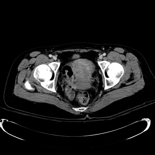 File:Acute myocardial infarction in CT (Radiopaedia 39947-42415 Axial C+ portal venous phase 126).jpg