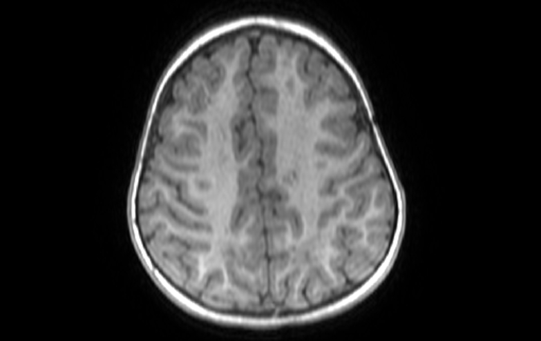 Acute necrotizing encephalitis of childhood (Radiopaedia 67356-76737 Axial T1 24).jpg