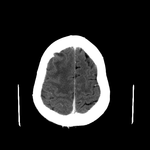 File:Acute necrotizing toxoplasma encephalitis (Radiopaedia 10683-11150 C+ arterial phase 7).jpg