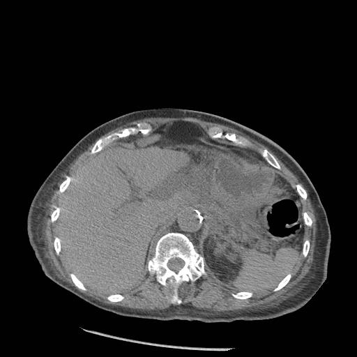 Acute on chronic pancreatitis (Radiopaedia 13233-13244 Axial non-contrast 14).jpg