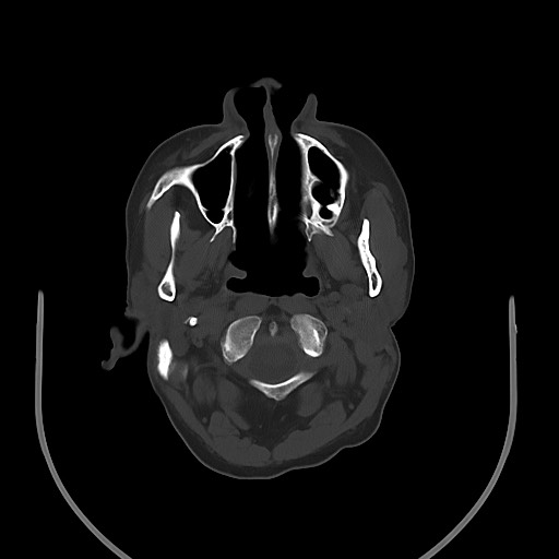 Acute on chronic subdural hematoma (Radiopaedia 74814-85823 D 24).jpg
