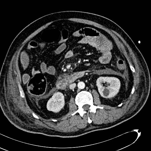 File:Acute pancreatic necrosis (Radiopaedia 13560-13486 Axial C+ portal venous phase 76).jpg