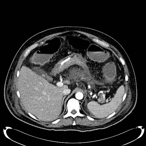 Acute pancreatic necrosis (Radiopaedia 13560-18500 Axial C+ portal venous phase 43).jpg