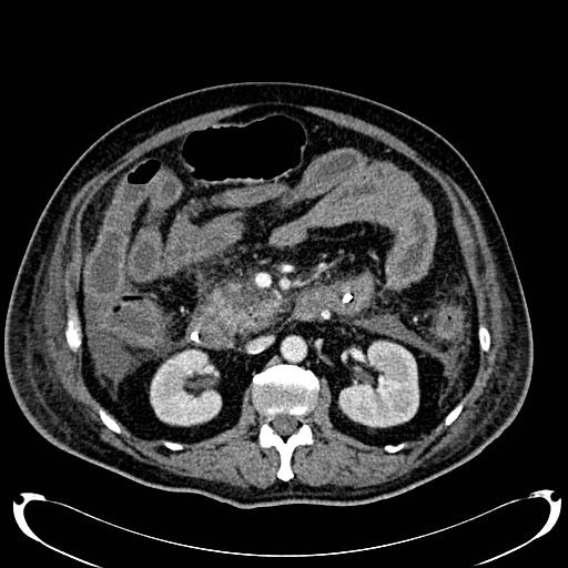 Acute pancreatic necrosis (Radiopaedia 13560-18500 Axial C+ portal venous phase 69).jpg