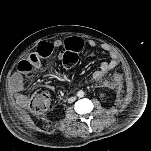 Acute pancreatic necrosis (Radiopaedia 13560-18501 Axial C+ portal venous phase 80).jpg
