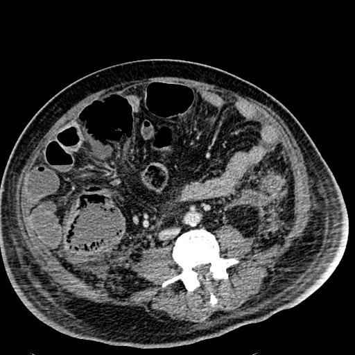 File:Acute pancreatic necrosis (Radiopaedia 13560-18501 Axial C+ portal venous phase 86).jpg