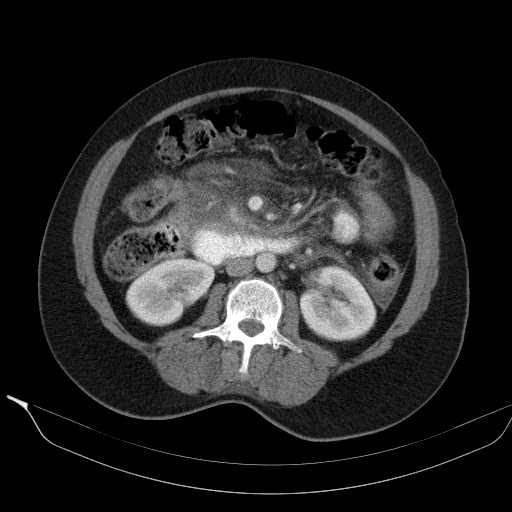 File:Acute pancreatitis (Radiopaedia 20829-20744 Axial C+ portal venous phase 23).jpg