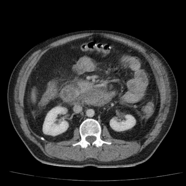 Acute pancreatitis (Radiopaedia 26663-26813 Axial C+ portal venous phase 39).jpg