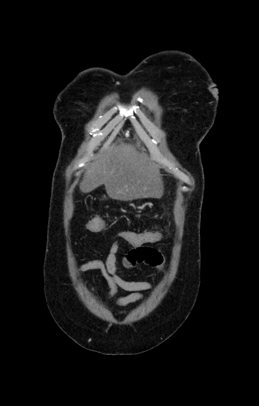 Acute pancreatitis (Radiopaedia 80007-93285 Coronal C+ portal venous phase 8).jpg