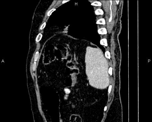 Acute pancreatitis (Radiopaedia 85146-100701 Sagittal C+ portal venous phase 83).jpg