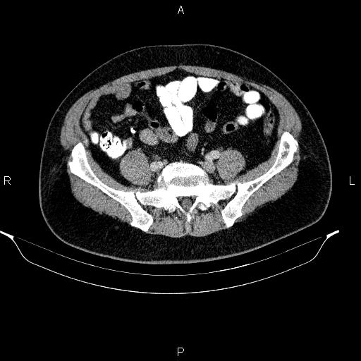 Acute pancreatitis (Radiopaedia 85390-101010 Axial C+ portal venous phase 79).jpg