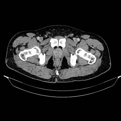Acute pancreatitis (Radiopaedia 87428-103757 Axial C+ portal venous phase 96).jpg