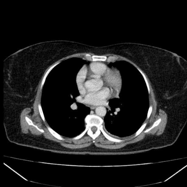 Acute pancreatitis - Balthazar C (Radiopaedia 26569-26714 Axial C+ portal venous phase 7).jpg