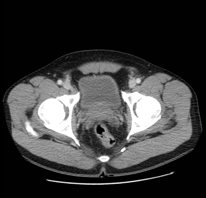 Acute pancreatitis - Balthazar E (Radiopaedia 23080-23110 Axial C+ portal venous phase 69).jpg