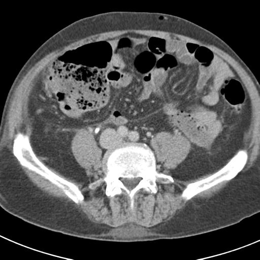 Acute pancreatitis and walled-off necrosis (Radiopaedia 29888-30403 Axial C+ delayed 55).jpg