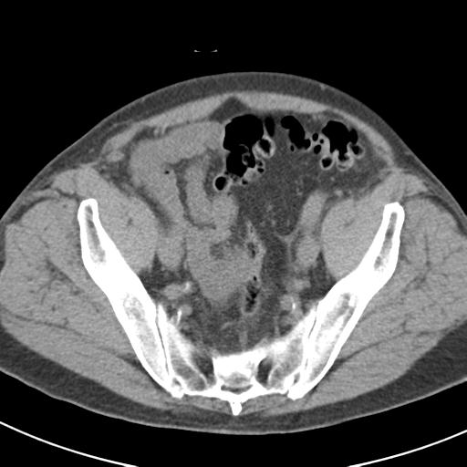 File:Acute pancreatitis and walled-off necrosis (Radiopaedia 29888-30403 Axial non-contrast 63).jpg