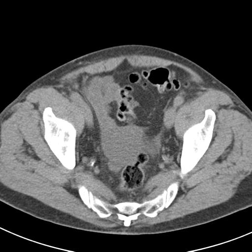 File:Acute pancreatitis and walled-off necrosis (Radiopaedia 29888-30403 Axial non-contrast 66).jpg